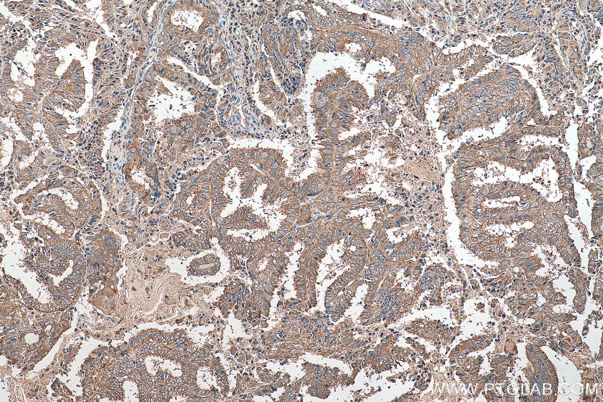 Immunohistochemical analysis of paraffin-embedded human ovary tumor tissue slide using KHC0717 (ARHGAP1 IHC Kit).