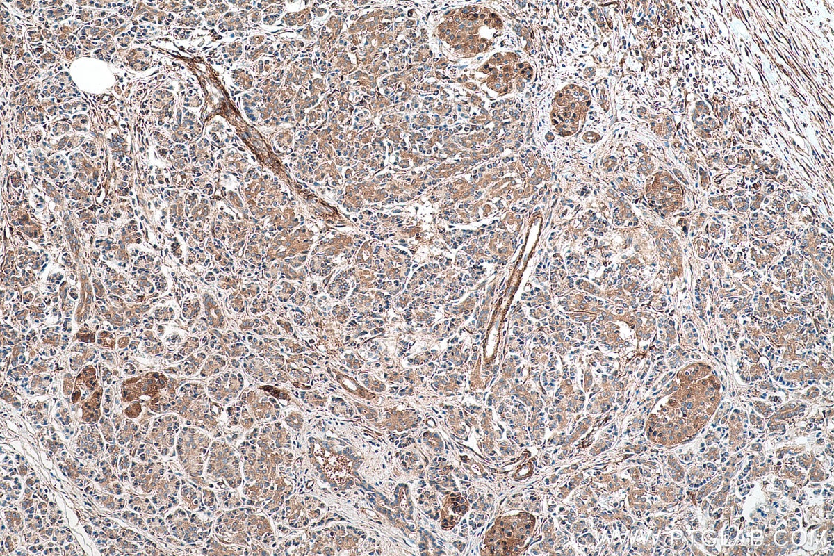 Immunohistochemical analysis of paraffin-embedded human pancreas cancer tissue slide using KHC0717 (ARHGAP1 IHC Kit).