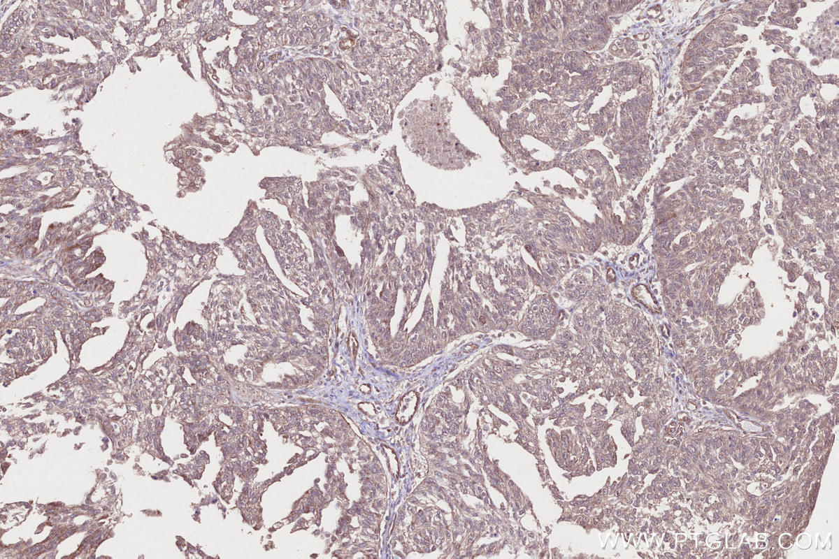 Immunohistochemical analysis of paraffin-embedded human ovary cancer tissue slide using KHC2669 (ARHGAP24 IHC Kit).