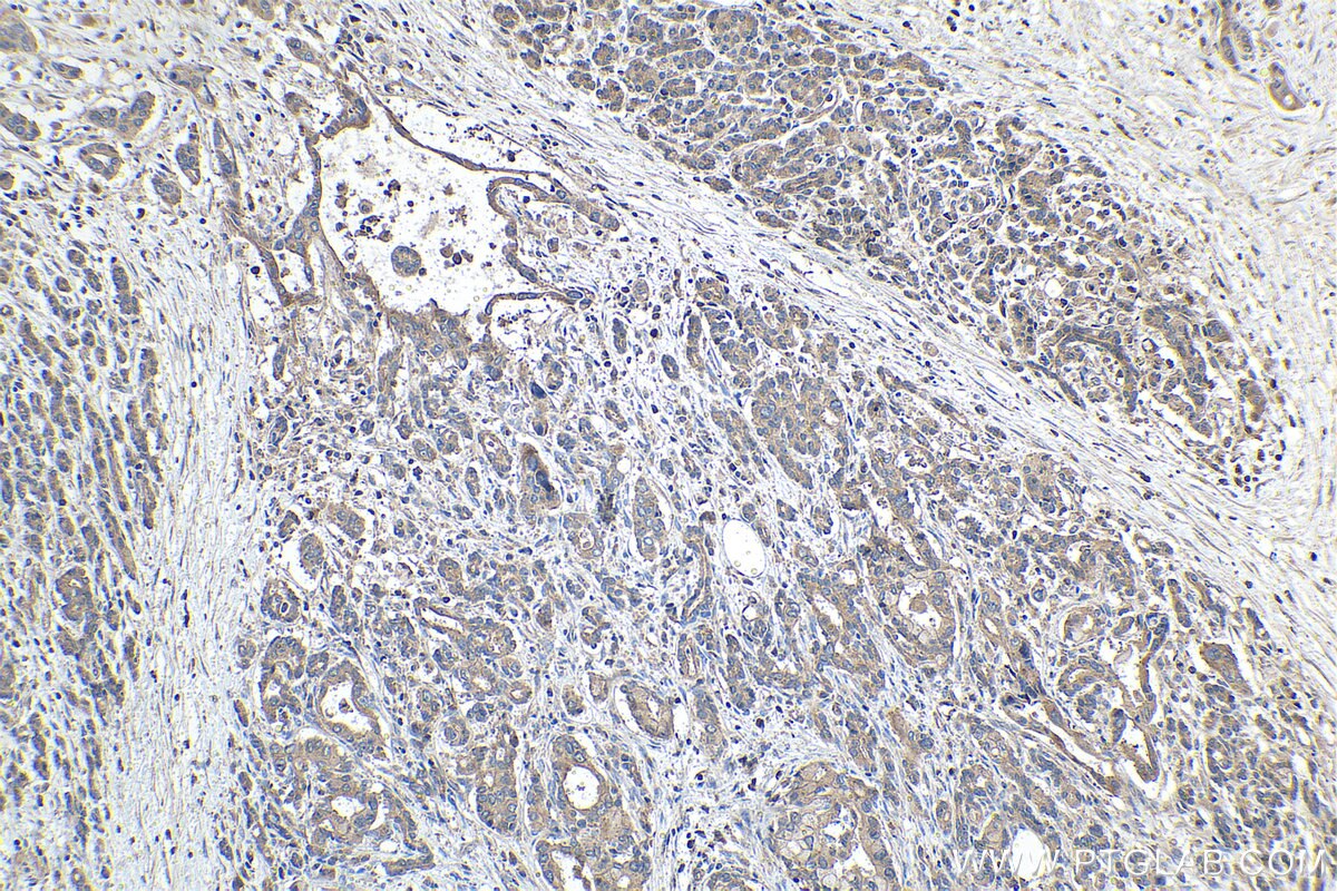 Immunohistochemical analysis of paraffin-embedded human pancreas cancer tissue slide using KHC1494 (ARHGAP29 IHC Kit).