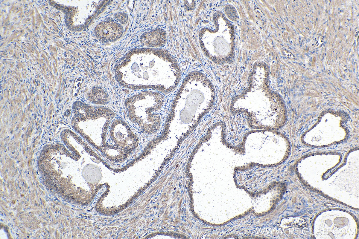 Immunohistochemical analysis of paraffin-embedded human prostate cancer tissue slide using KHC1494 (ARHGAP29 IHC Kit).