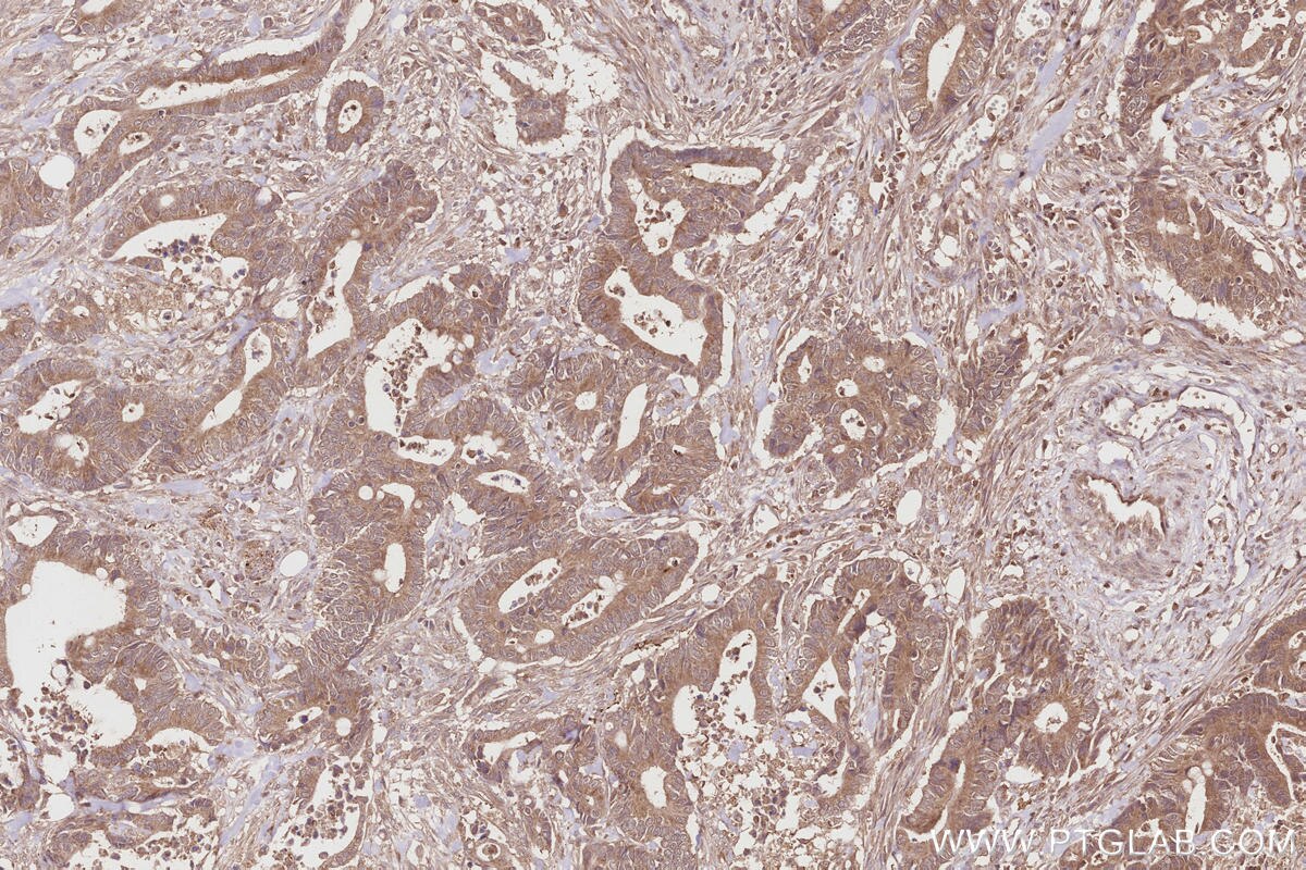 Immunohistochemical analysis of paraffin-embedded human rectal cancer tissue slide using KHC2857 (ARHGAP9 IHC Kit).