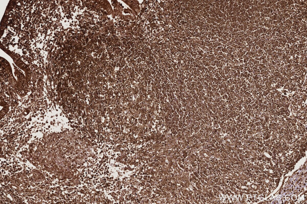 Immunohistochemical analysis of paraffin-embedded human appendicitis tissue slide using KHC2764 (ARHGEF1 IHC Kit). Immunohistochemical analysis of paraffin-embedded human appendicitis tissue slide using KHC2764 (ARHGEF1 IHC Kit).