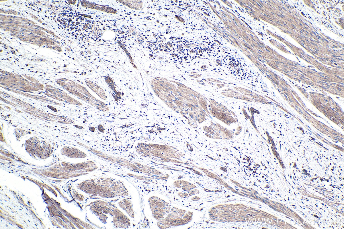 Immunohistochemical analysis of paraffin-embedded human urothelial carcinoma tissue slide using KHC1690 (ARHGEF5 IHC Kit).
