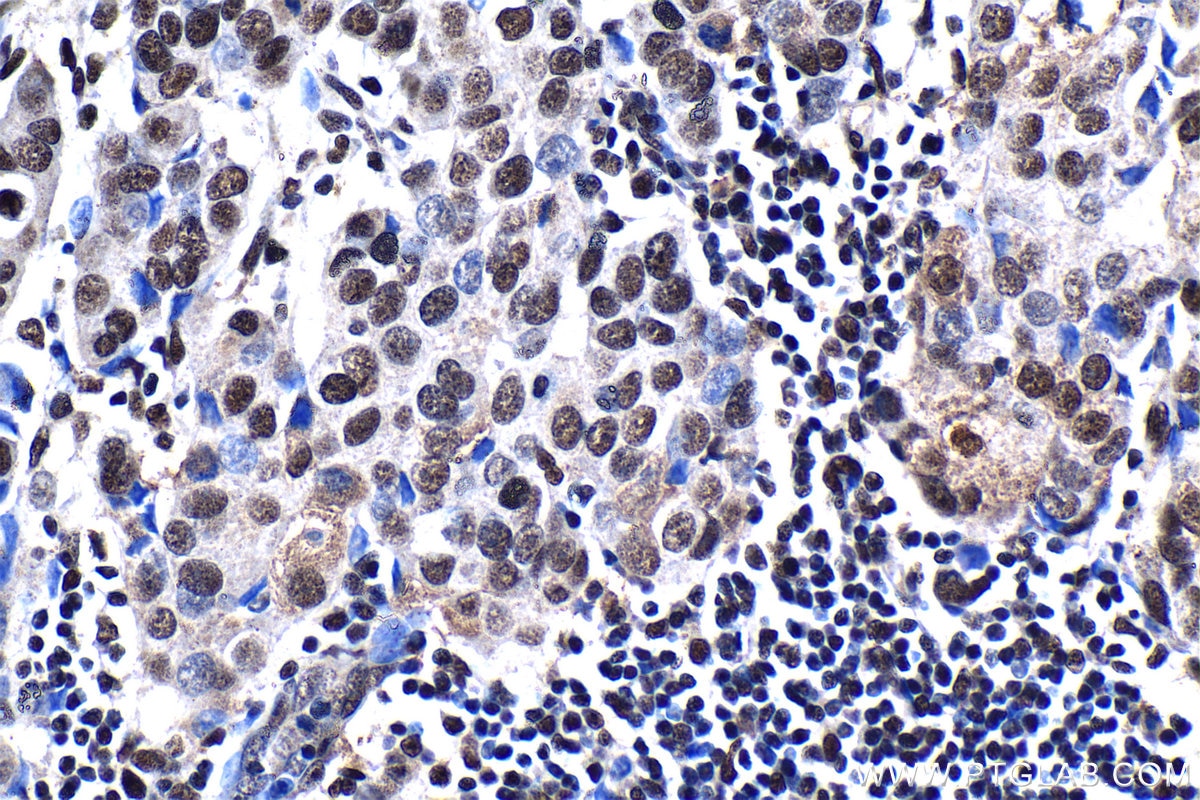 Immunohistochemical analysis of paraffin-embedded human breast cancer tissue slide using KHC1329 (ARID1A IHC Kit).