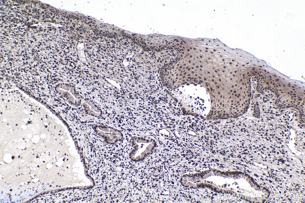 Immunohistochemical analysis of paraffin-embedded human cervical cancer tissue slide using KHC1772 (ARID4B IHC Kit).