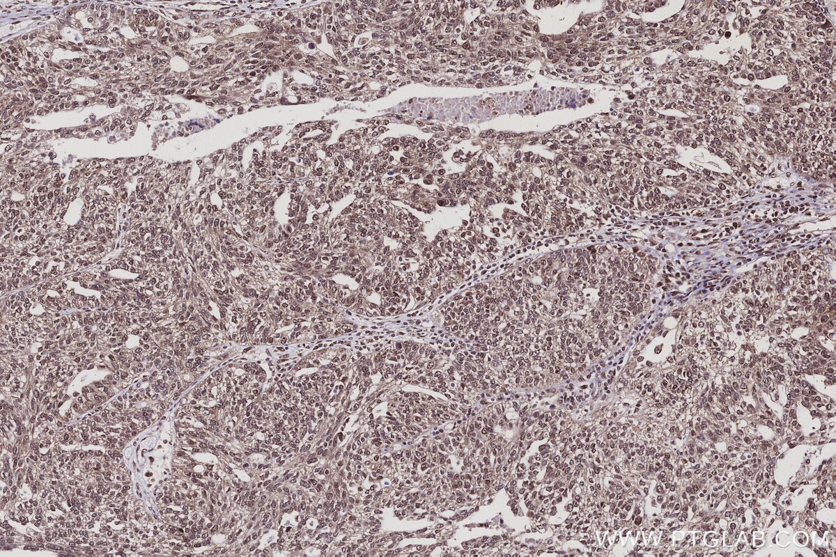 Immunohistochemical analysis of paraffin-embedded human ovary cancer tissue slide using KHC3120 (ARMCX3 IHC Kit). Immunohistochemical analysis of paraffin-embedded human ovary cancer tissue slide using KHC3120 (ARMCX3 IHC Kit).