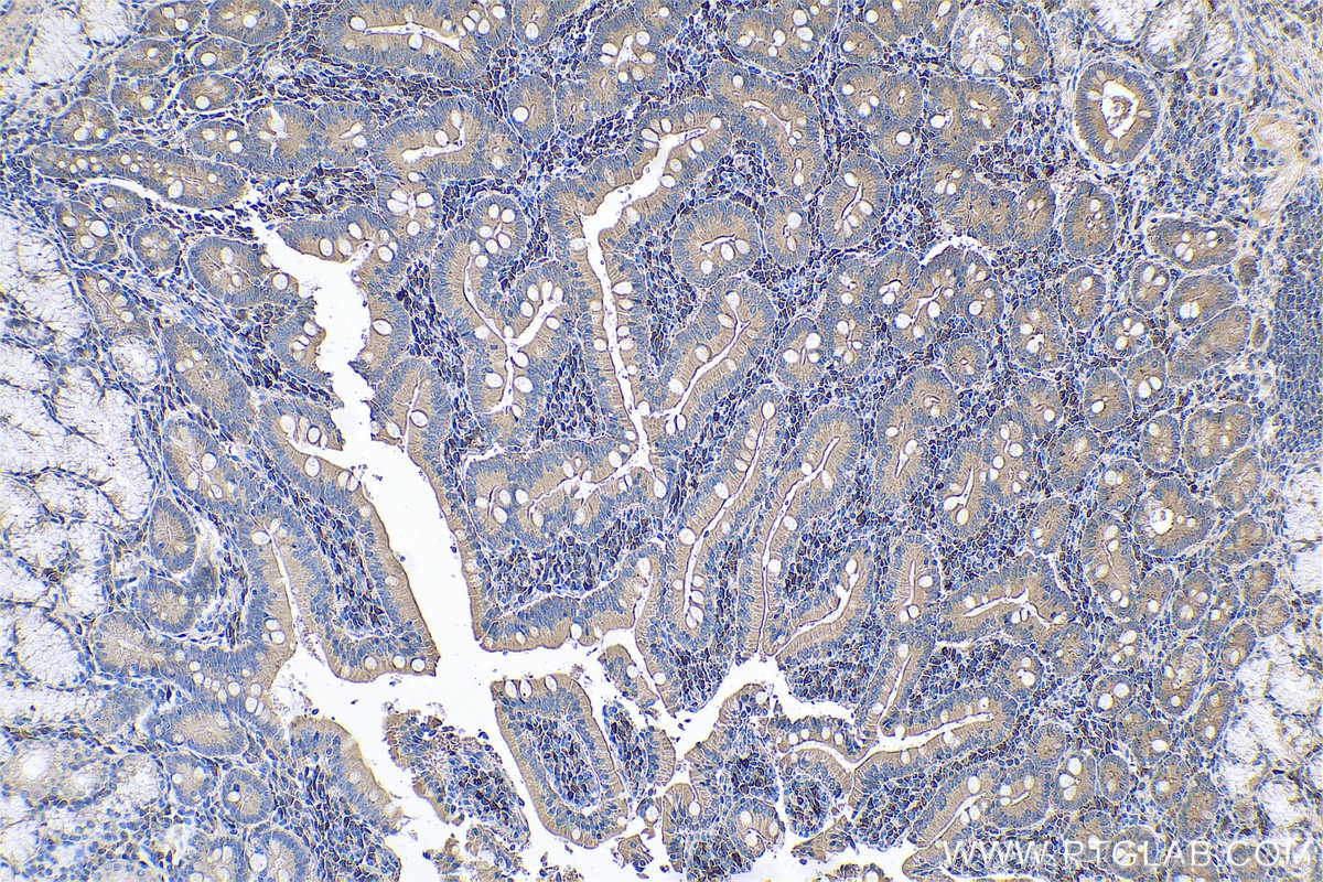 Immunohistochemical analysis of paraffin-embedded human stomach cancer tissue slide using KHC0686 (ARMET IHC Kit).