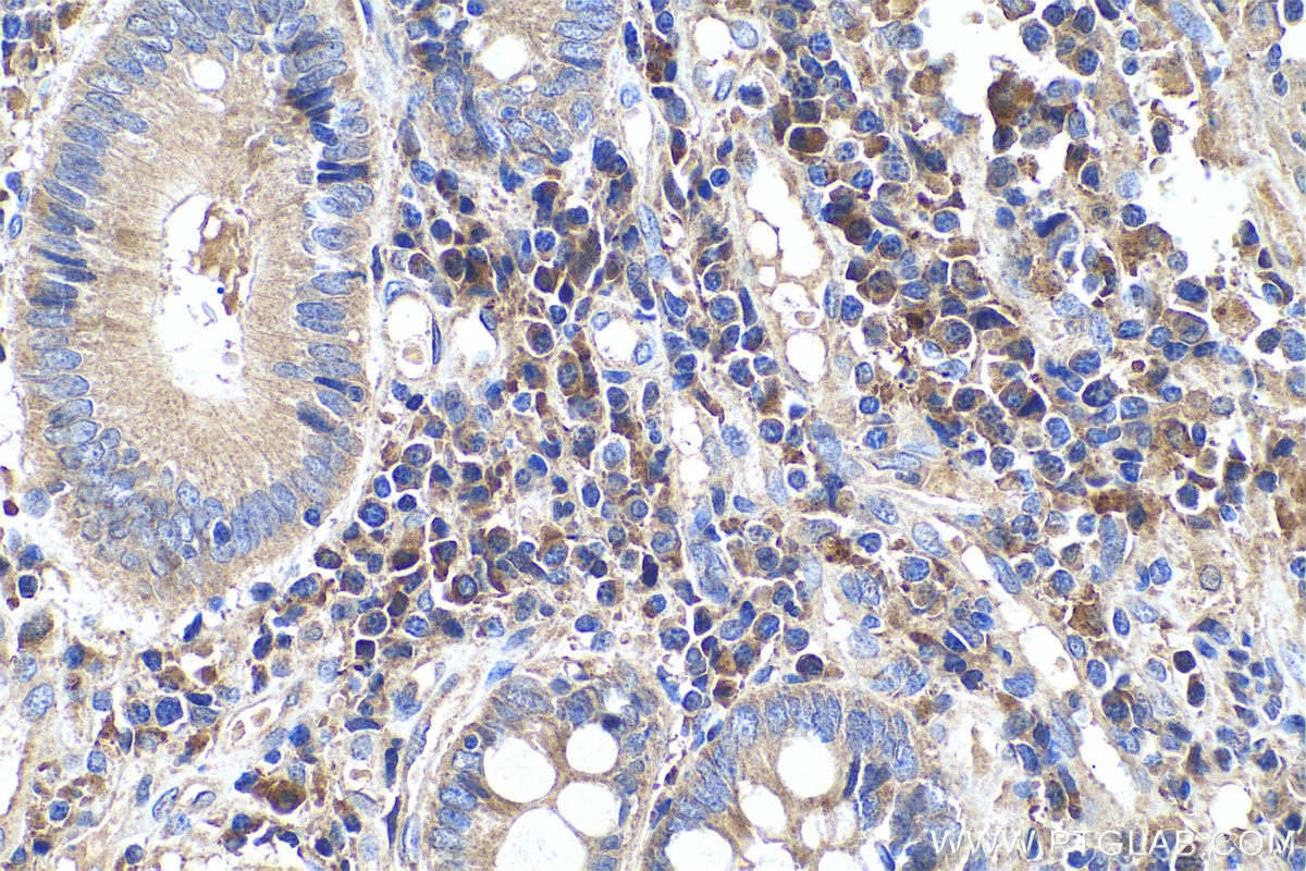 Immunohistochemical analysis of paraffin-embedded human colon cancer tissue slide using KHC0686 (ARMET IHC Kit).