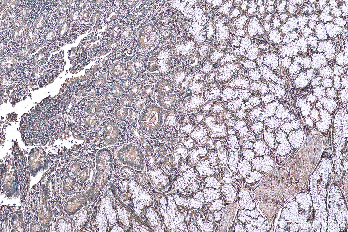 Immunohistochemical analysis of paraffin-embedded human stomach cancer tissue slide using KHC0622 (ARPC1B IHC Kit).