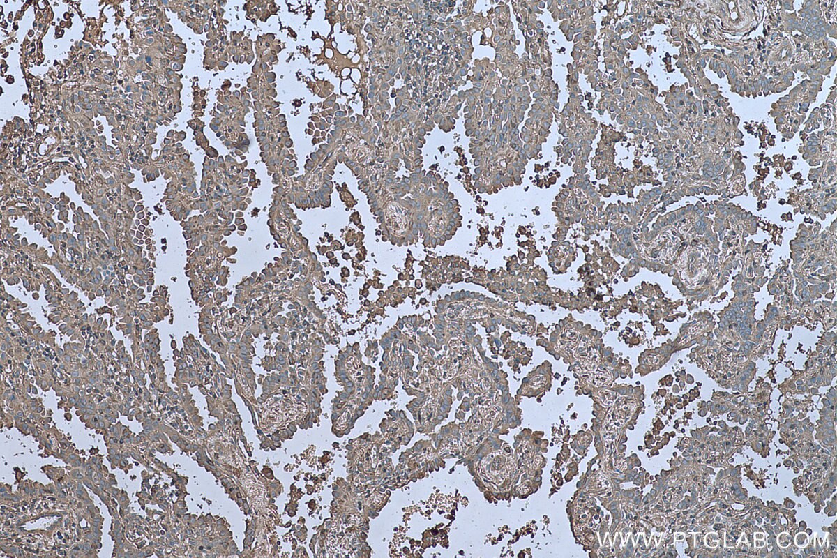 Immunohistochemical analysis of paraffin-embedded human lung cancer tissue slide using KHC0622 (ARPC1B IHC Kit).