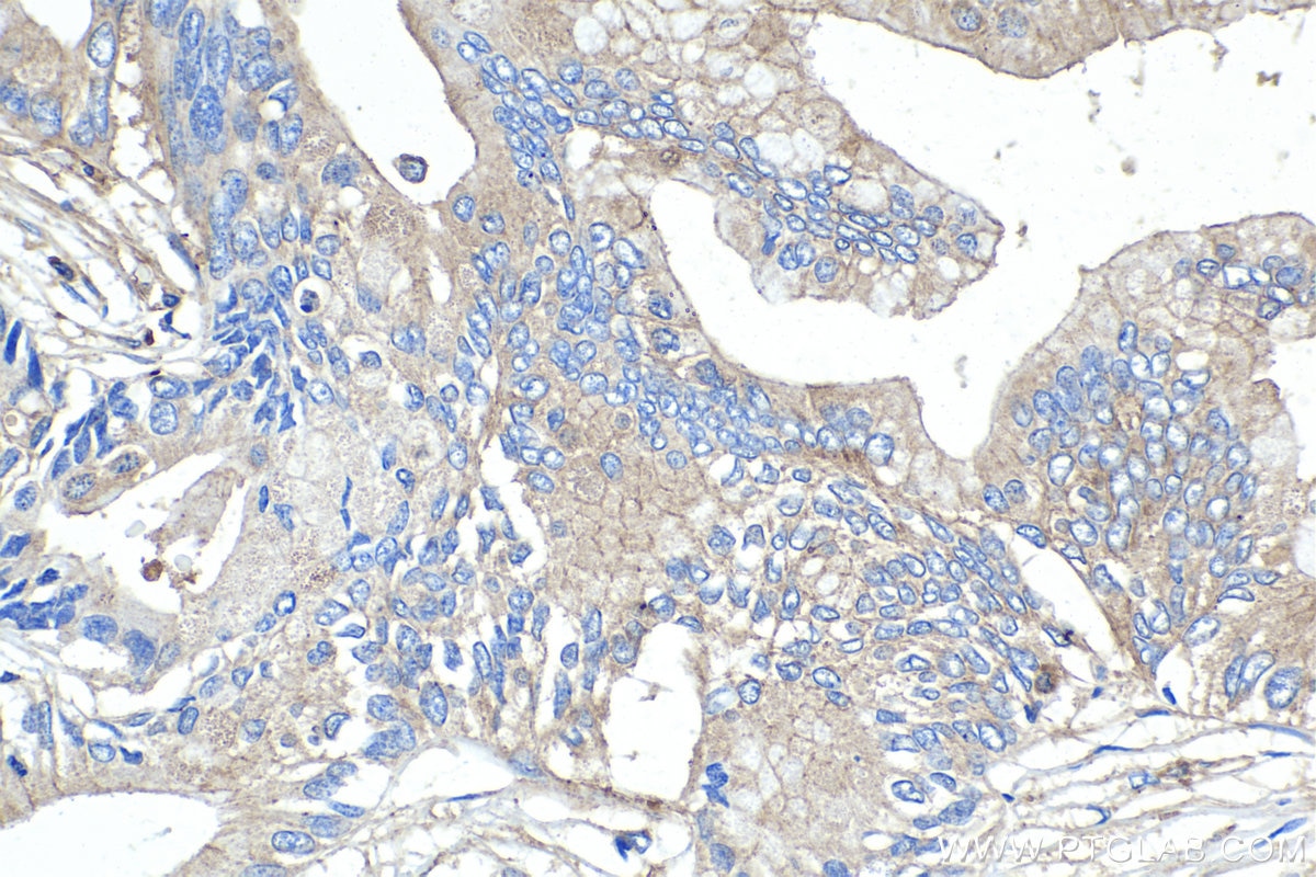 Immunohistochemical analysis of paraffin-embedded human pancreas cancer tissue slide using KHC1434 (ARPC2 IHC Kit).
