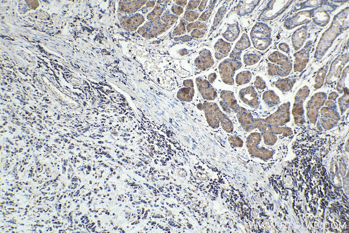 Immunohistochemical analysis of paraffin-embedded human stomach cancer tissue slide using KHC1434 (ARPC2 IHC Kit).