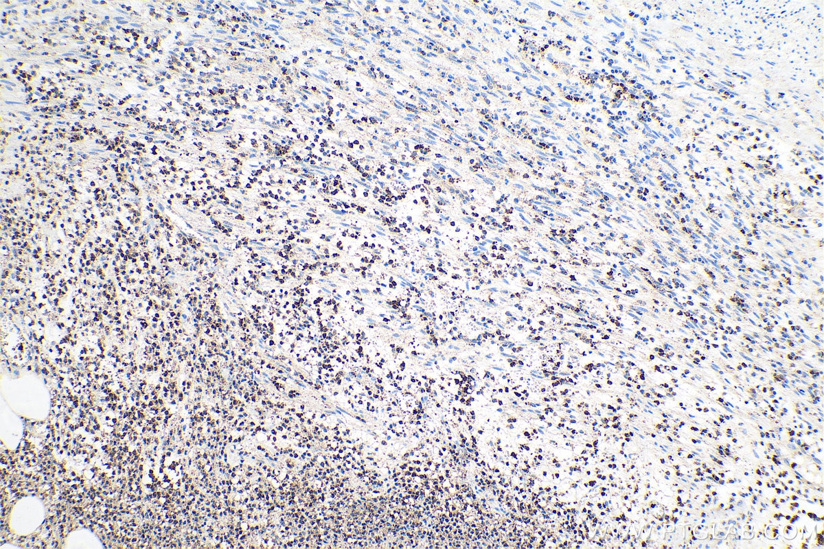 Immunohistochemical analysis of paraffin-embedded human appendicitis tissue slide using KHC0704 (ARPC3 IHC Kit).