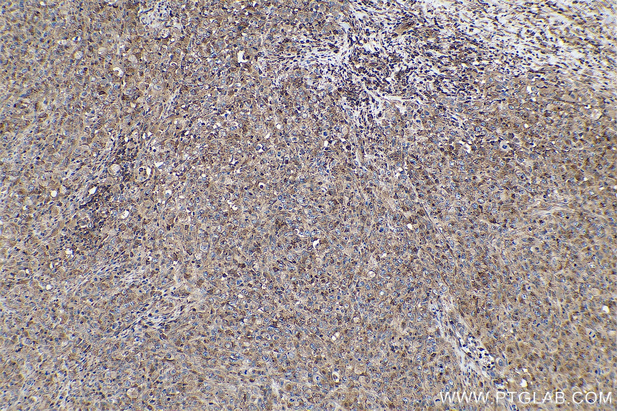 Immunohistochemical analysis of paraffin-embedded human lymphoma tissue slide using KHC0704 (ARPC3 IHC Kit).