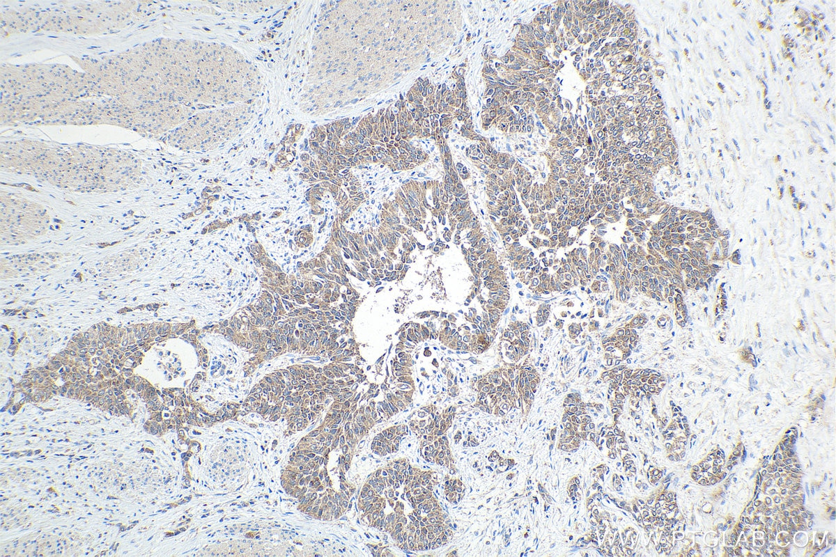 Immunohistochemical analysis of paraffin-embedded human urothelial carcinoma tissue slide using KHC1636 (ARPC4 IHC Kit).