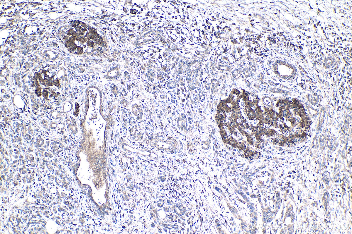 Immunohistochemical analysis of paraffin-embedded human pancreas cancer tissue slide using KHC1445 (ARPC5 IHC Kit).