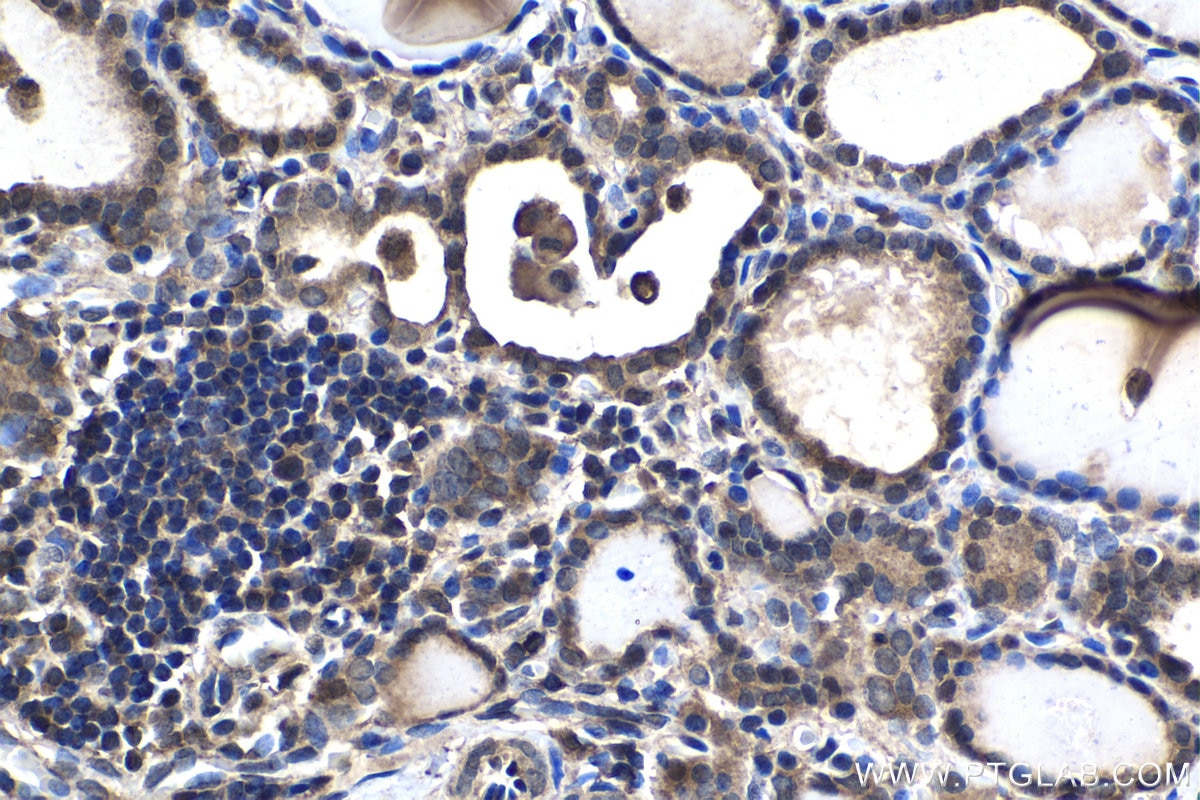 Immunohistochemical analysis of paraffin-embedded human thyroid cancer tissue slide using KHC1445 (ARPC5 IHC Kit).