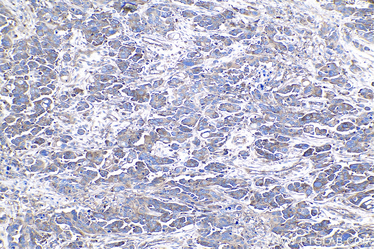 Immunohistochemical analysis of paraffin-embedded human colon cancer tissue slide using KHC1039 (ARPP19 IHC Kit).