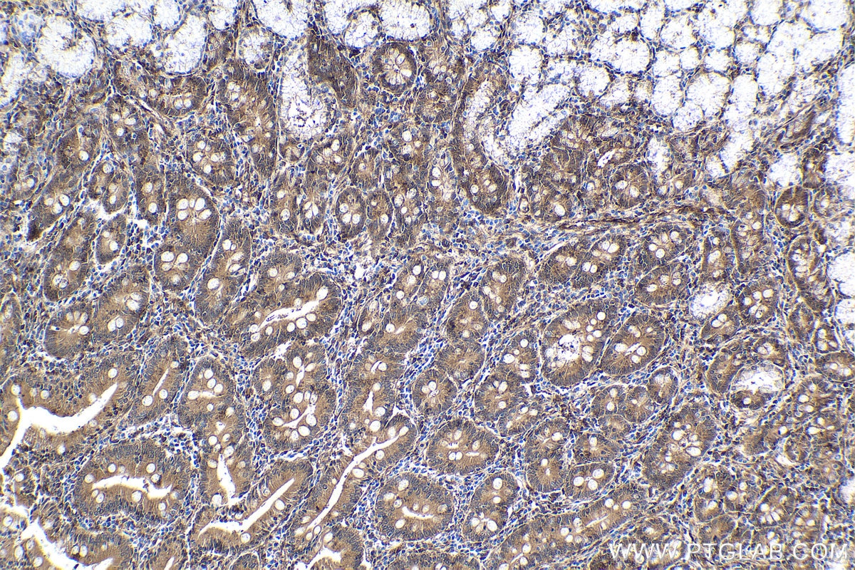 Immunohistochemical analysis of paraffin-embedded human stomach cancer tissue slide using KHC1612 (ARRB1 IHC Kit).