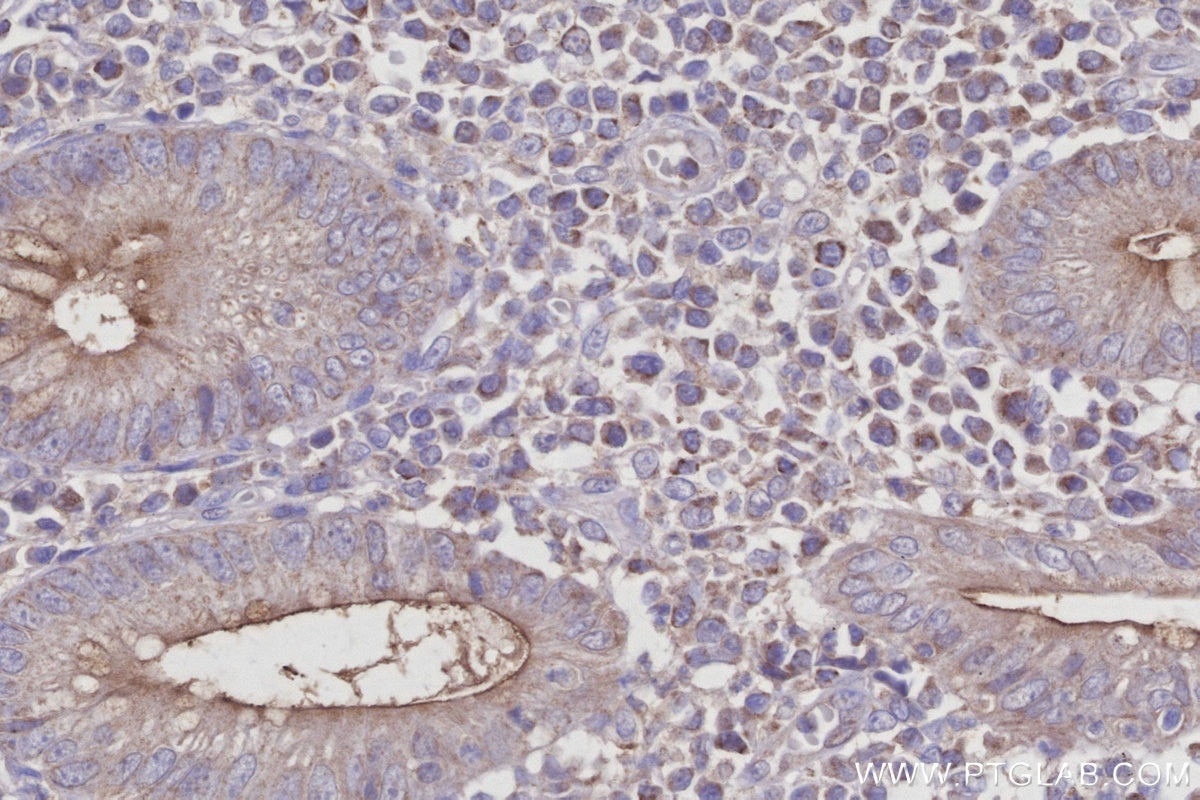 Immunohistochemical analysis of paraffin-embedded human appendicitis tissue slide using KHC2948 (ASAH2 IHC Kit).