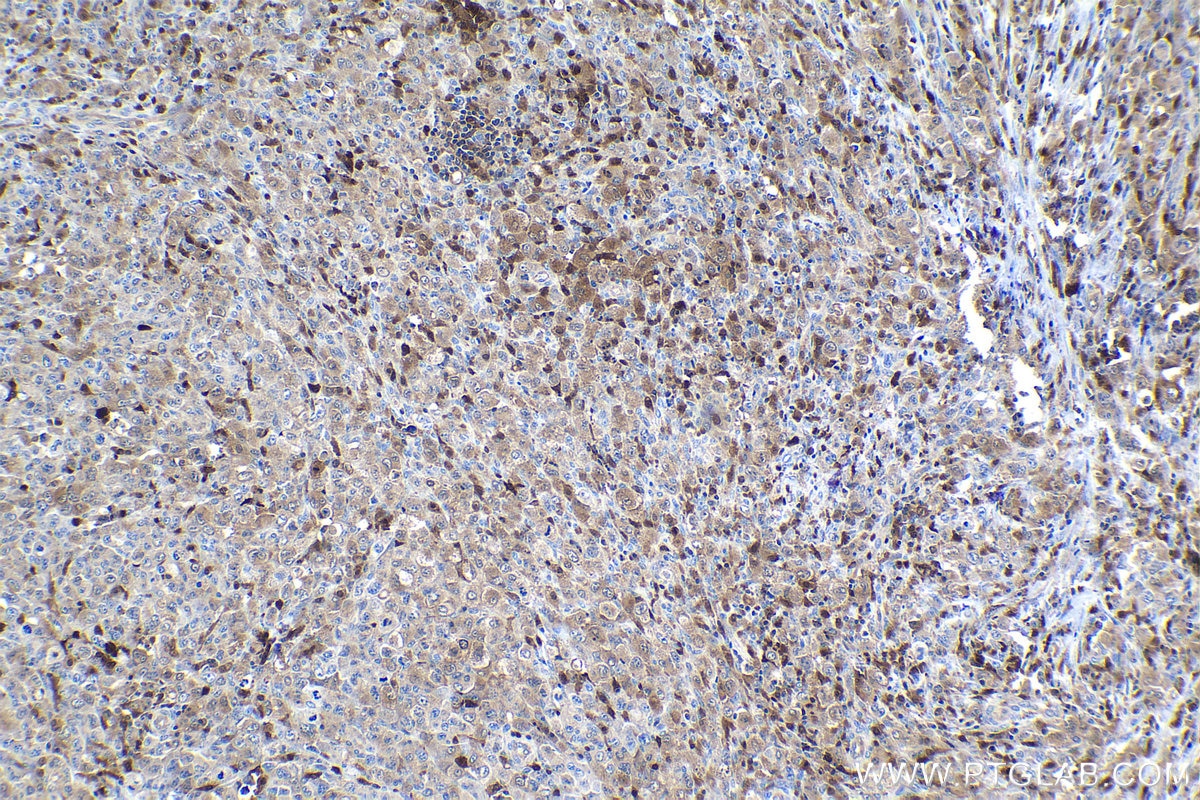 Immunohistochemical analysis of paraffin-embedded human lymphoma tissue slide using KHC1080 (ASC/TMS1 IHC Kit).
