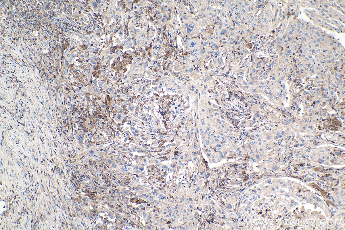 Immunohistochemical analysis of paraffin-embedded human lung cancer tissue slide using KHC1080 (ASC/TMS1 IHC Kit).