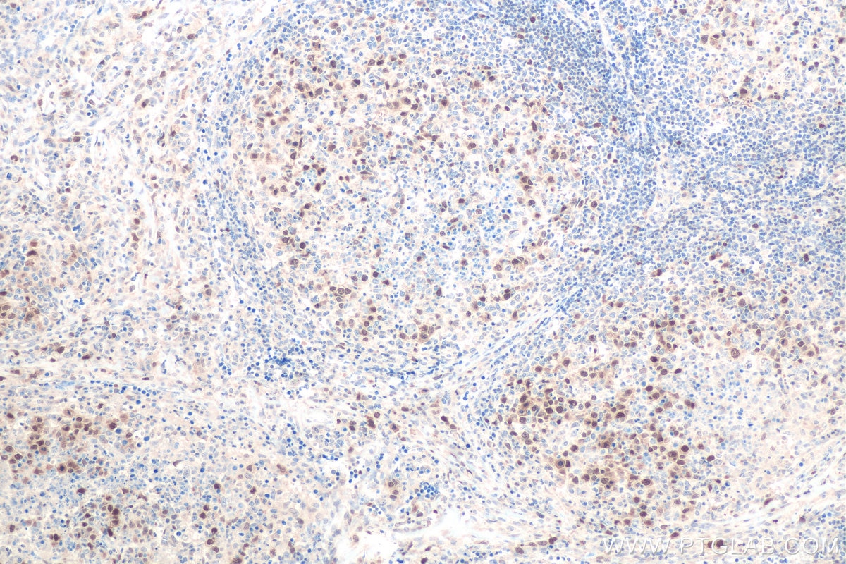 Immunohistochemical analysis of paraffin-embedded human lymphoma tissue slide using KHC0880 (ASF1B IHC Kit).