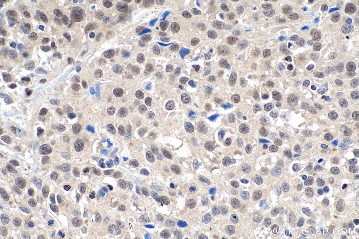 Immunohistochemical analysis of paraffin-embedded human cervical cancer tissue slide using KHC0880 (ASF1B IHC Kit).