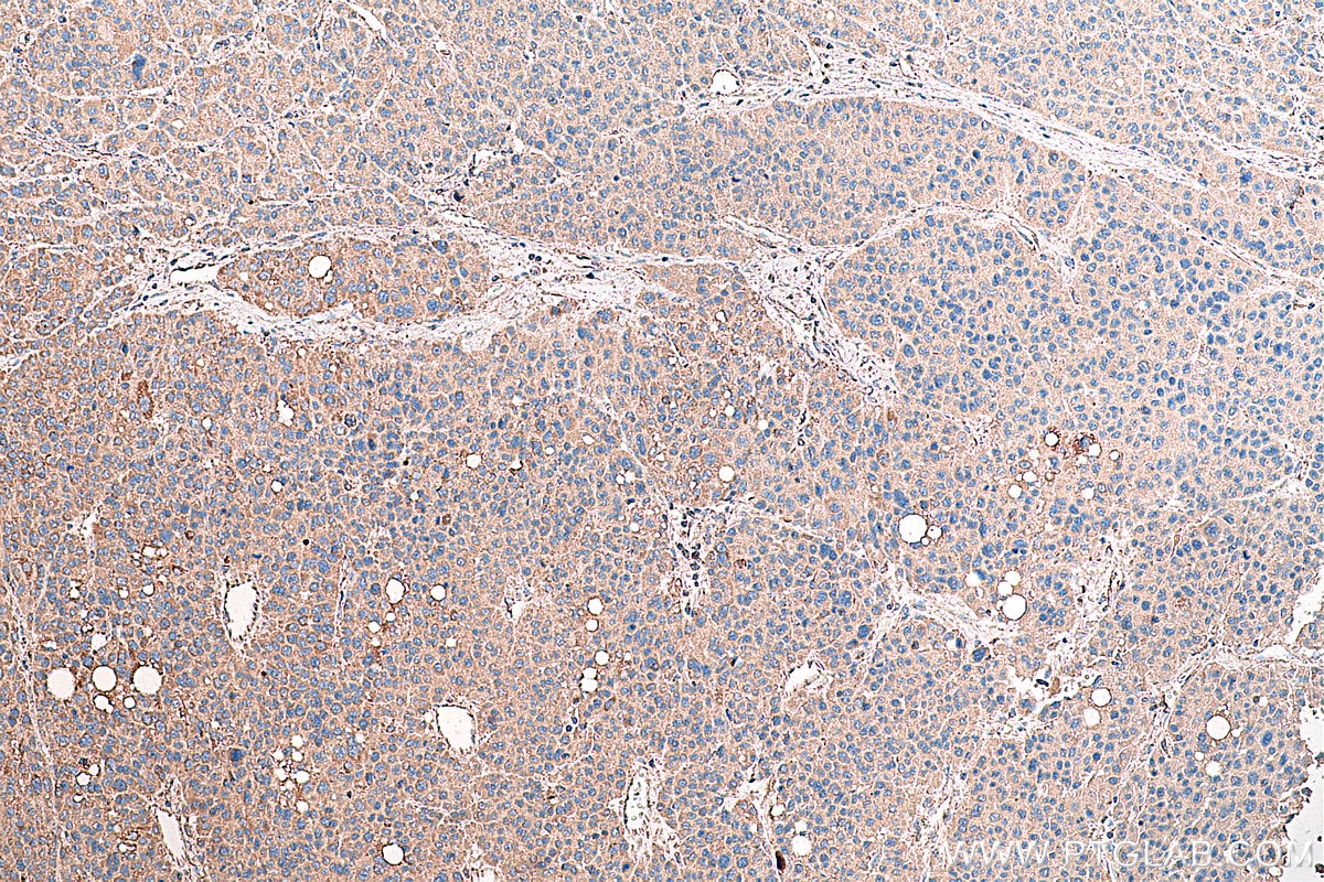 Immunohistochemical analysis of paraffin-embedded human liver cancer tissue slide using KHC0384 (ASGR1 IHC Kit).