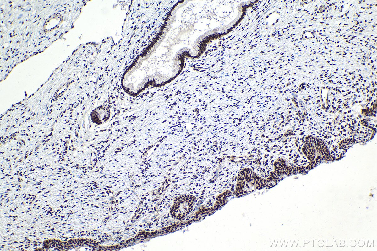 Immunohistochemical analysis of paraffin-embedded human cervical cancer tissue slide using KHC1975 (ASH2L IHC Kit).