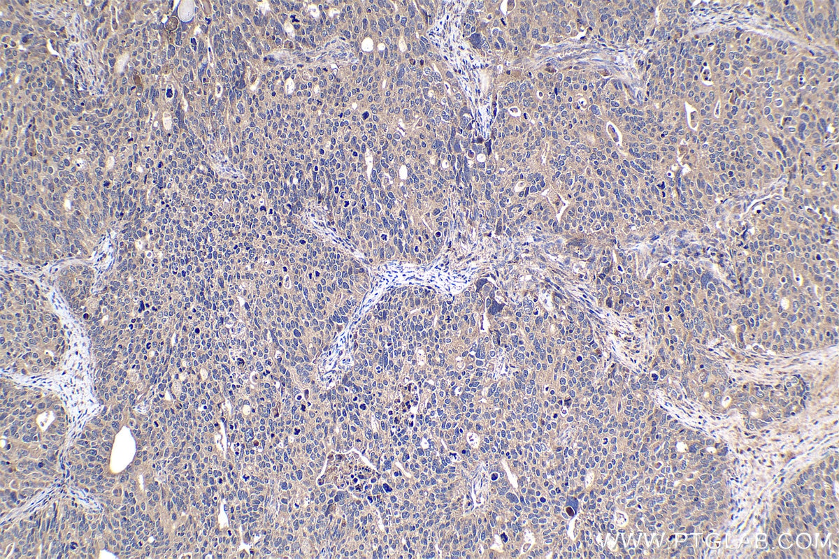 Immunohistochemical analysis of paraffin-embedded human ovary tumor tissue slide using KHC1086 (ASPM IHC Kit).