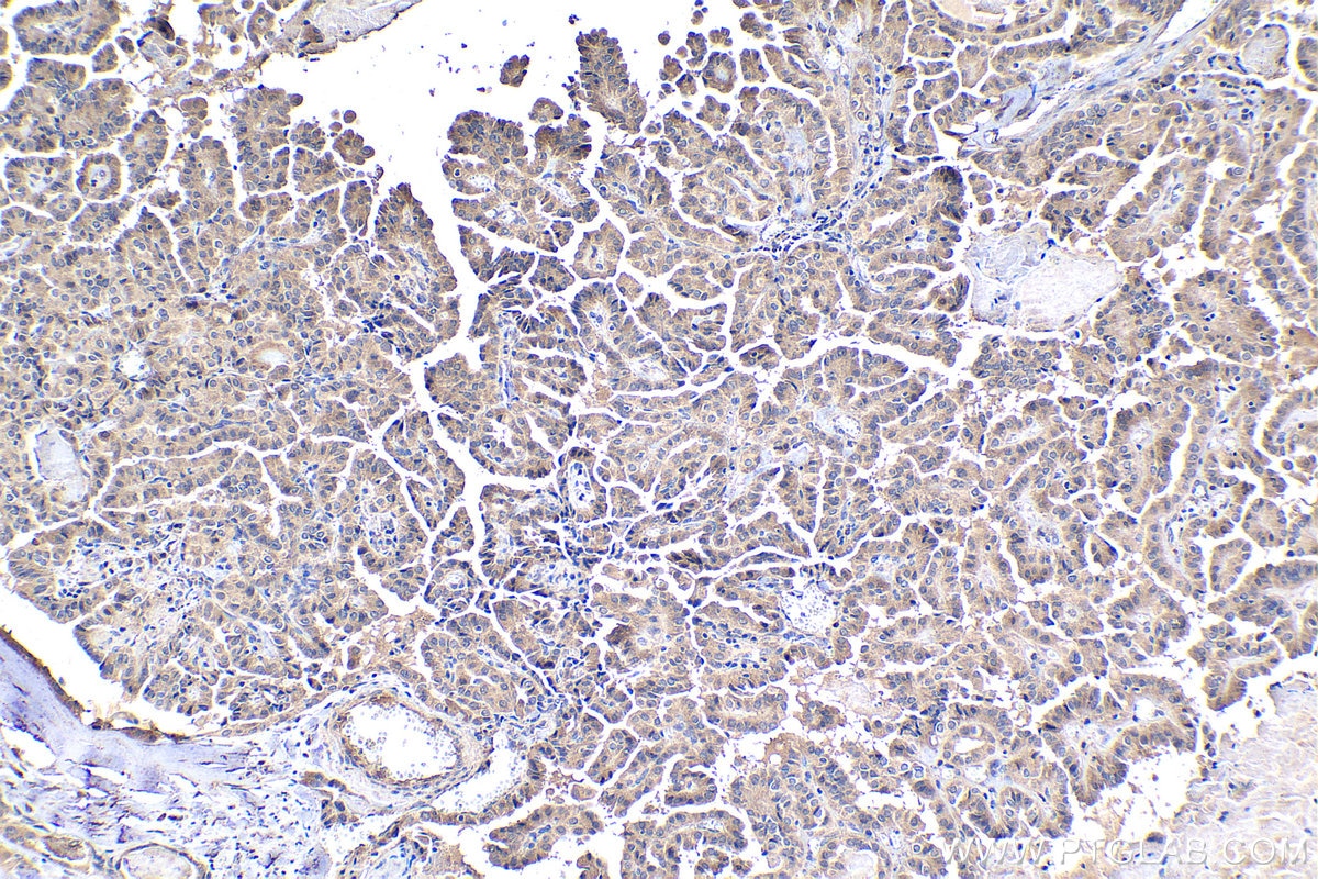 Immunohistochemical analysis of paraffin-embedded human thyroid cancer tissue slide using KHC1086 (ASPM IHC Kit).