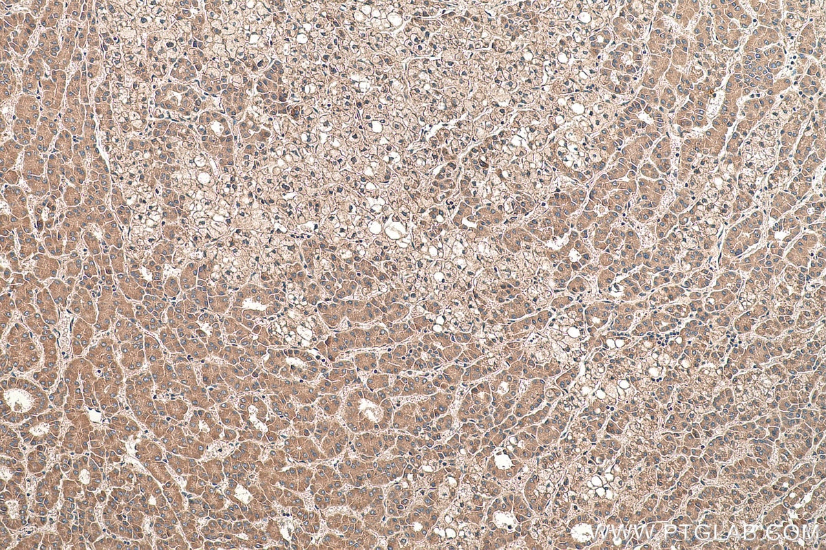 Immunohistochemical analysis of paraffin-embedded human liver cancer tissue slide using KHC0400 (ASUN IHC Kit).