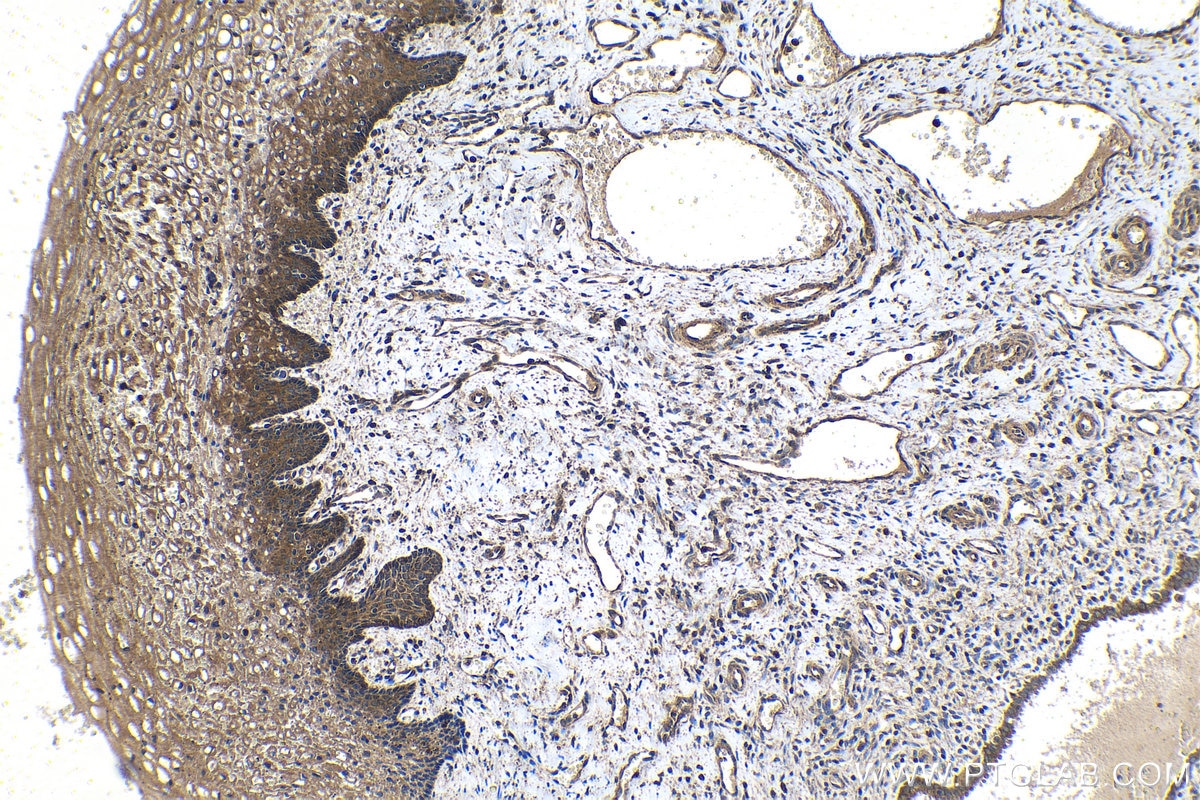 Immunohistochemical analysis of paraffin-embedded human cervical cancer tissue slide using KHC1543 (ATF4 IHC Kit).