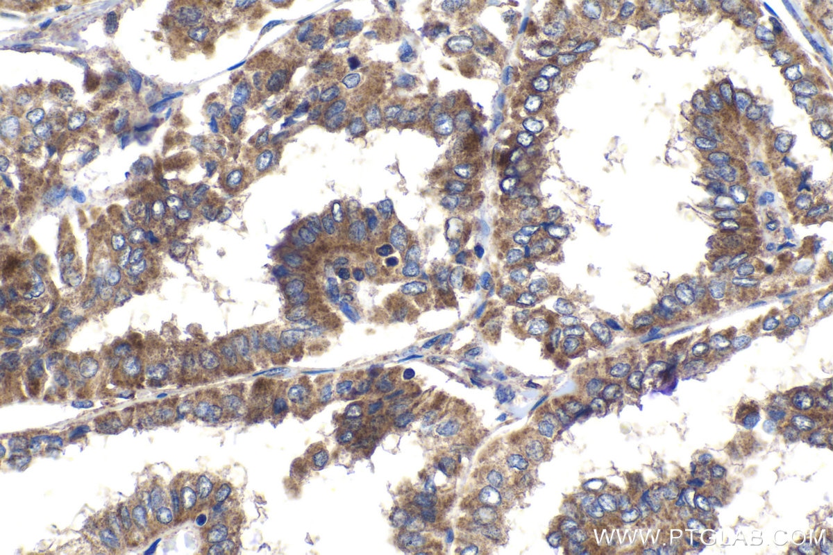 Immunohistochemical analysis of paraffin-embedded human thyroid cancer tissue slide using KHC1543 (ATF4 IHC Kit).