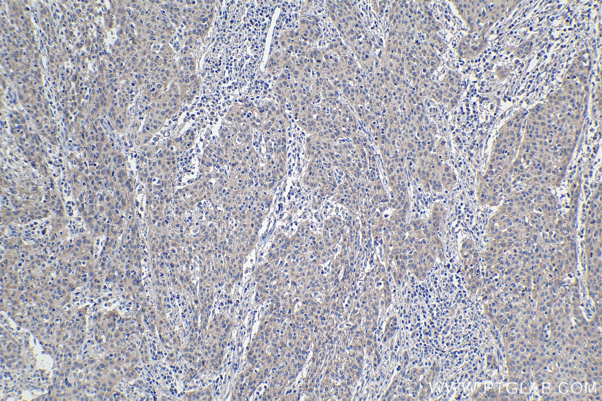 Immunohistochemical analysis of paraffin-embedded human cervical cancer tissue slide using KHC1115 (ATF6 IHC Kit).