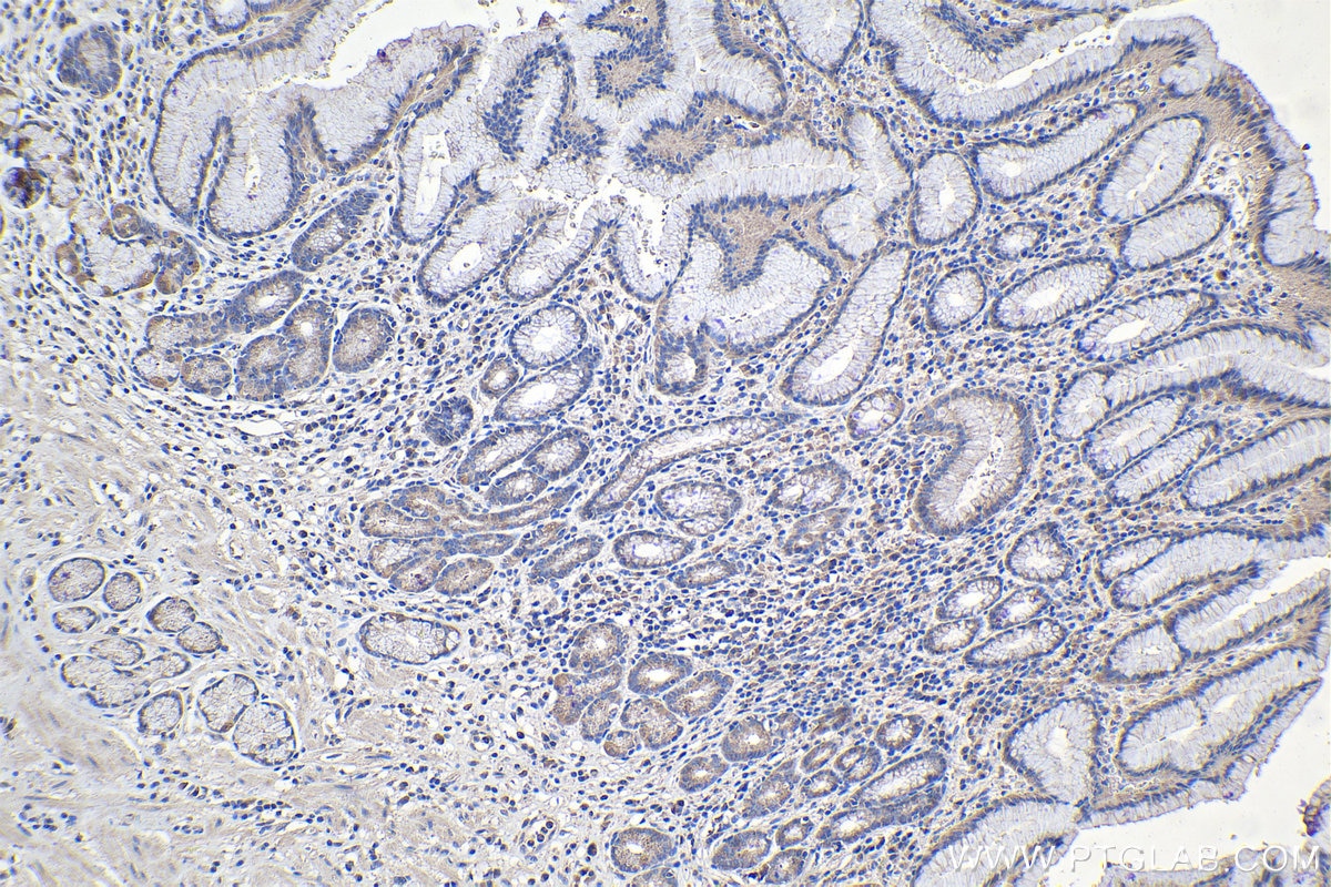 Immunohistochemical analysis of paraffin-embedded human stomach cancer tissue slide using KHC1115 (ATF6 IHC Kit).