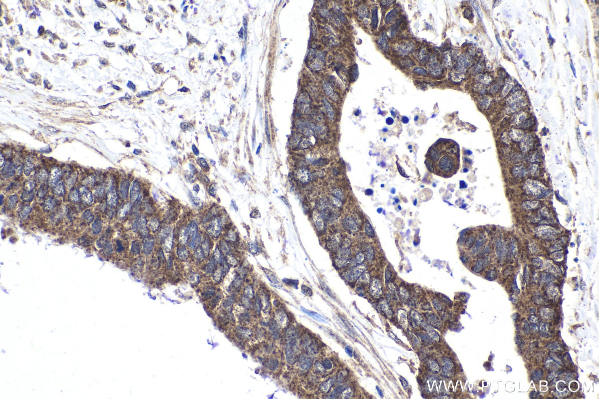 Immunohistochemical analysis of paraffin-embedded human urothelial carcinoma tissue slide using KHC1899 (ATF6B IHC Kit).
