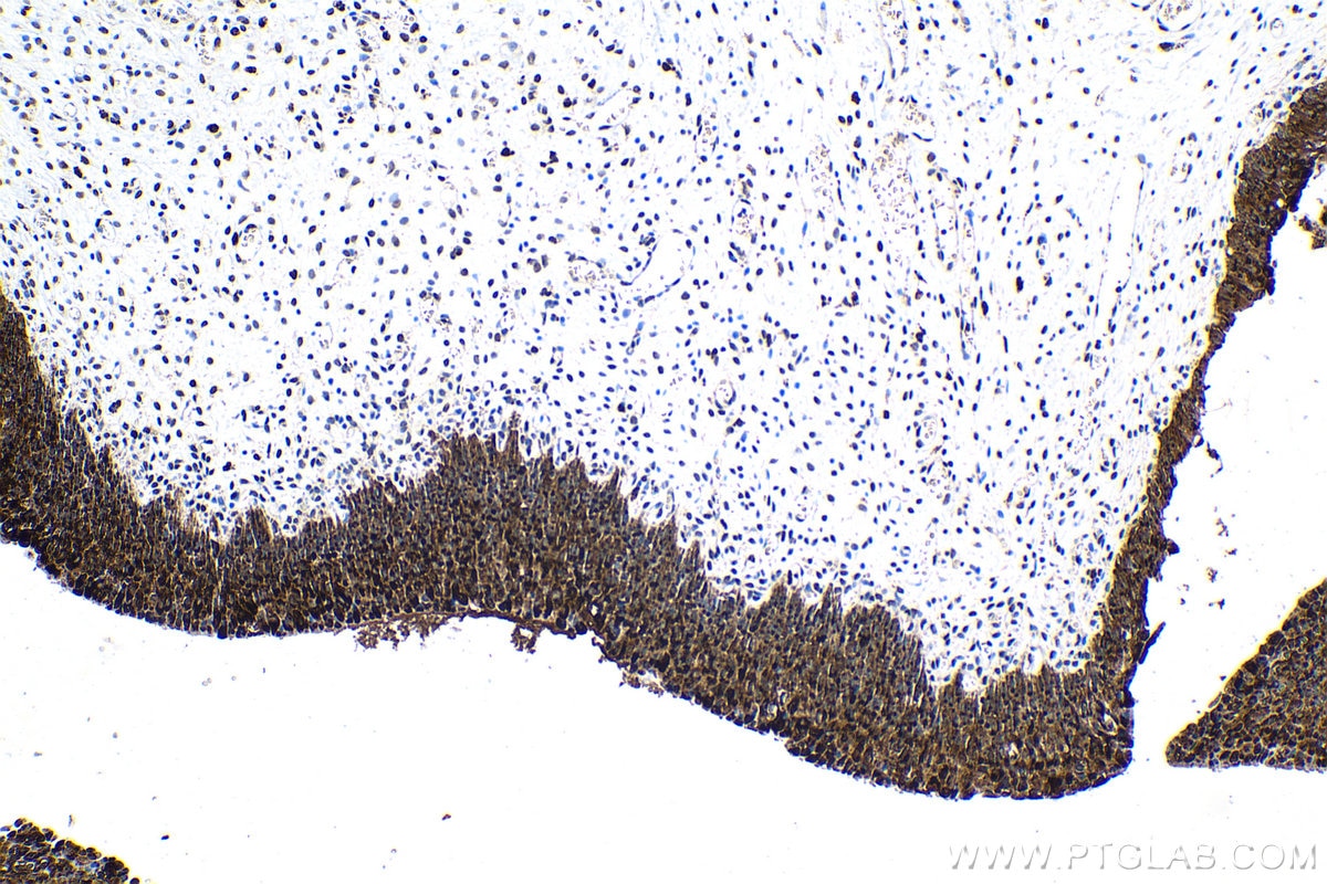 Immunohistochemical analysis of paraffin-embedded human urothelial carcinoma tissue slide using KHC1553 (ATF7 IHC Kit).