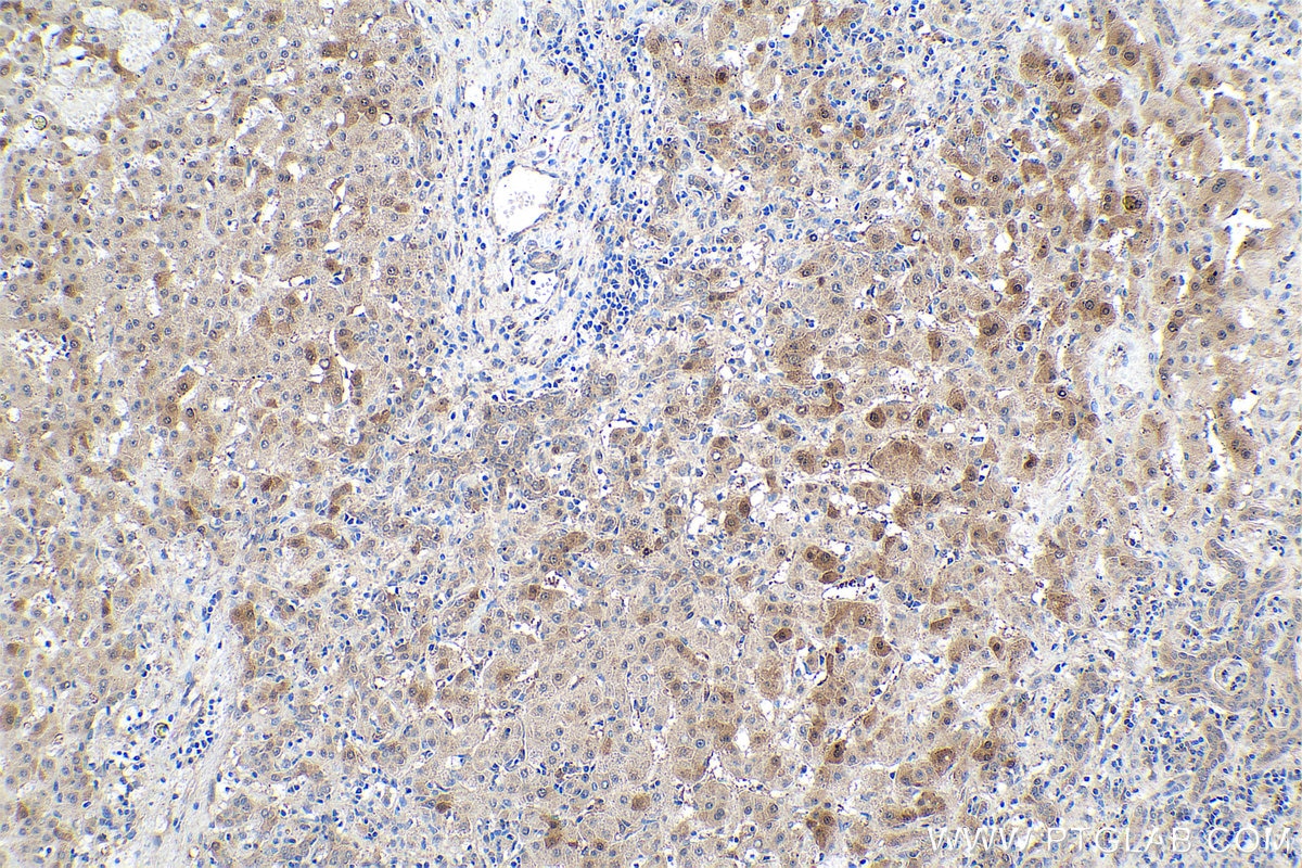 Immunohistochemical analysis of paraffin-embedded human liver cancer tissue slide using KHC0932 (ATOX1 IHC Kit).