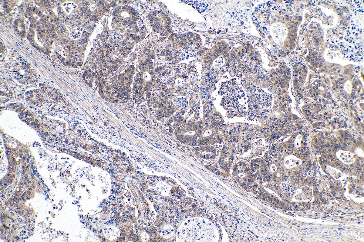 Immunohistochemical analysis of paraffin-embedded human stomach cancer tissue slide using KHC0932 (ATOX1 IHC Kit).