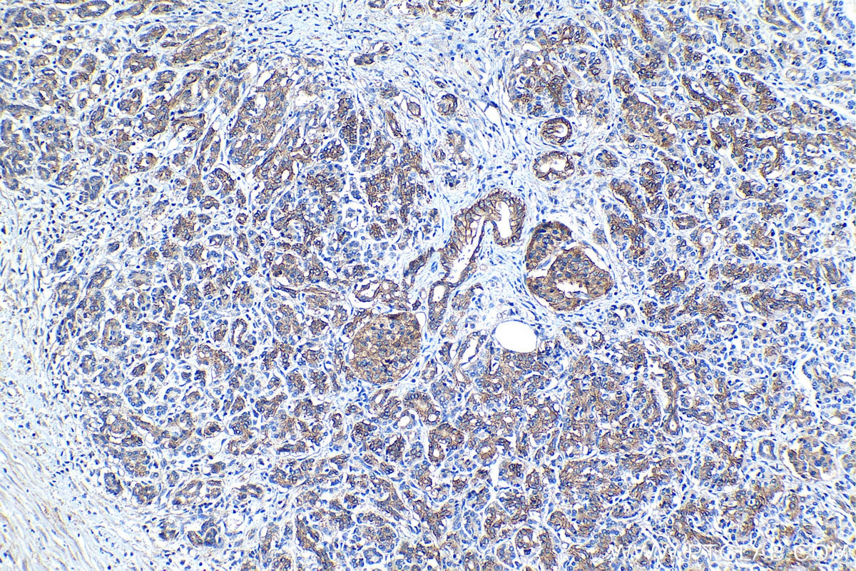 Immunohistochemical analysis of paraffin-embedded human pancreas cancer tissue slide using KHC1274 (ATP1A3 IHC Kit).