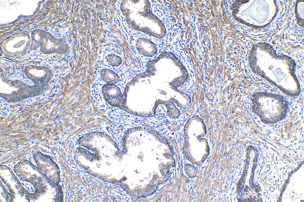 Immunohistochemical analysis of paraffin-embedded human prostate cancer tissue slide using KHC1274 (ATP1A3 IHC Kit).