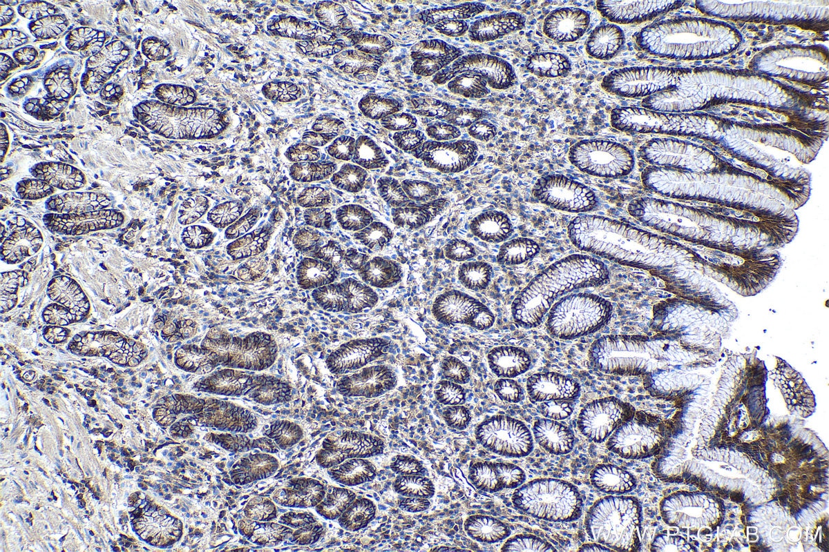 Immunohistochemical analysis of paraffin-embedded human stomach cancer tissue slide using KHC1117 (ATP2B1 IHC Kit).
