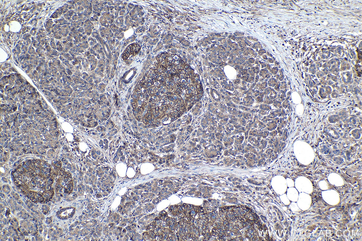 Immunohistochemical analysis of paraffin-embedded human pancreas cancer tissue slide using KHC1117 (ATP2B1 IHC Kit).