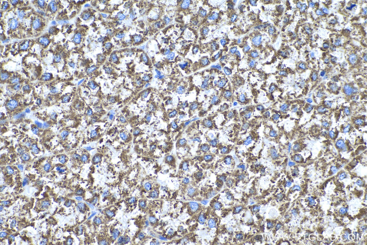 Immunohistochemical analysis of paraffin-embedded human liver cancer tissue slide using KHC0530 (ATP5A1 IHC Kit).