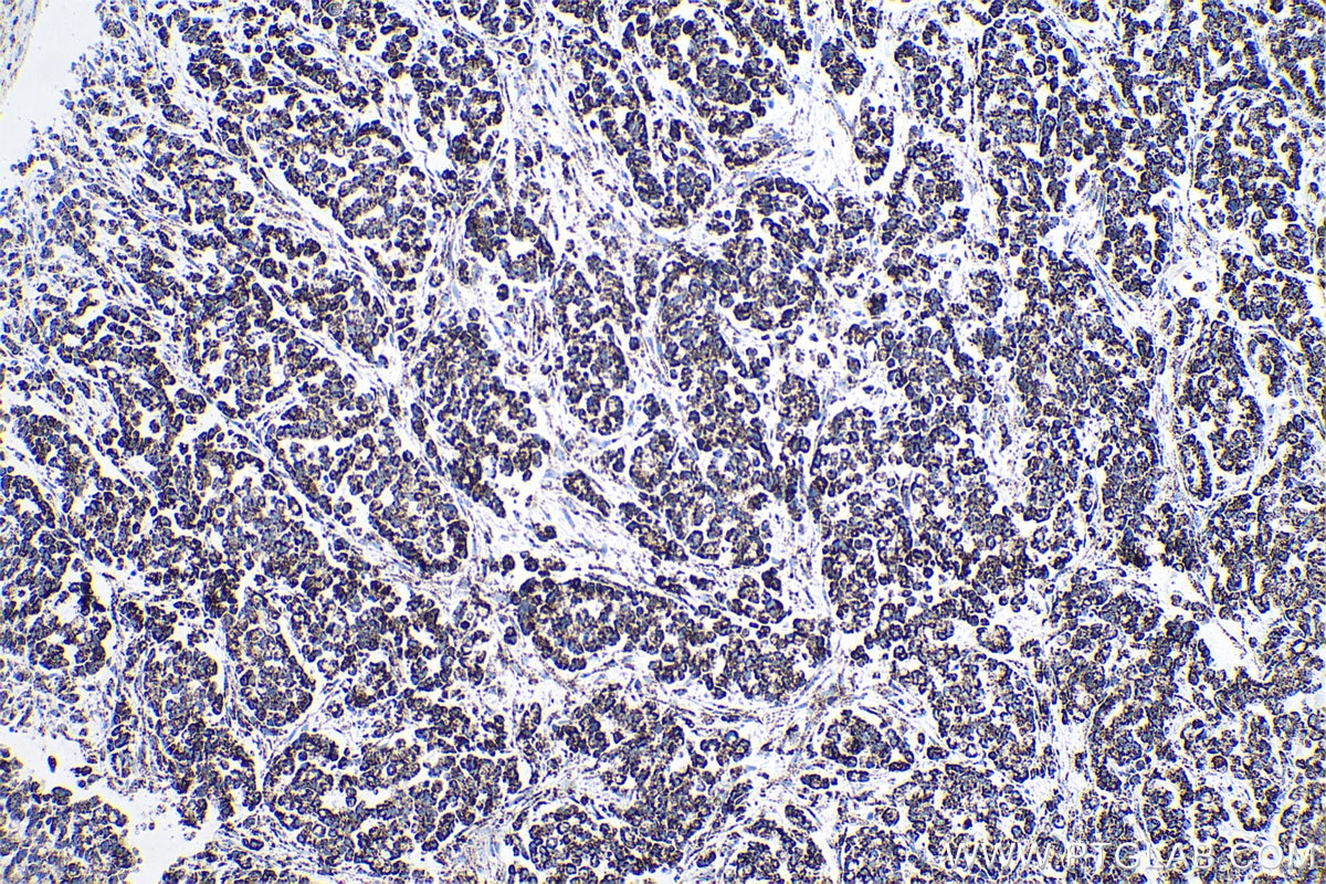 Immunohistochemical analysis of paraffin-embedded human colon cancer tissue slide using KHC0530 (ATP5A1 IHC Kit).