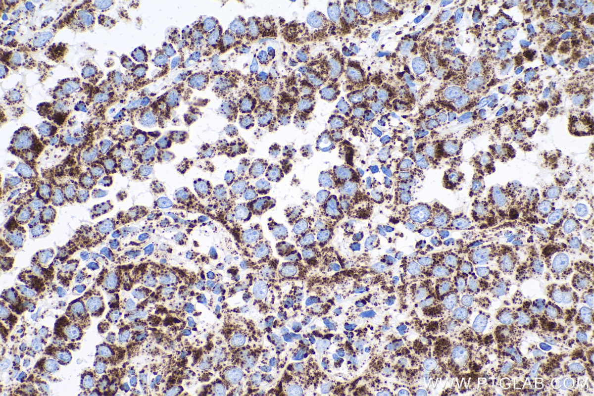 Immunohistochemical analysis of paraffin-embedded human lung cancer tissue slide using KHC0530 (ATP5A1 IHC Kit).