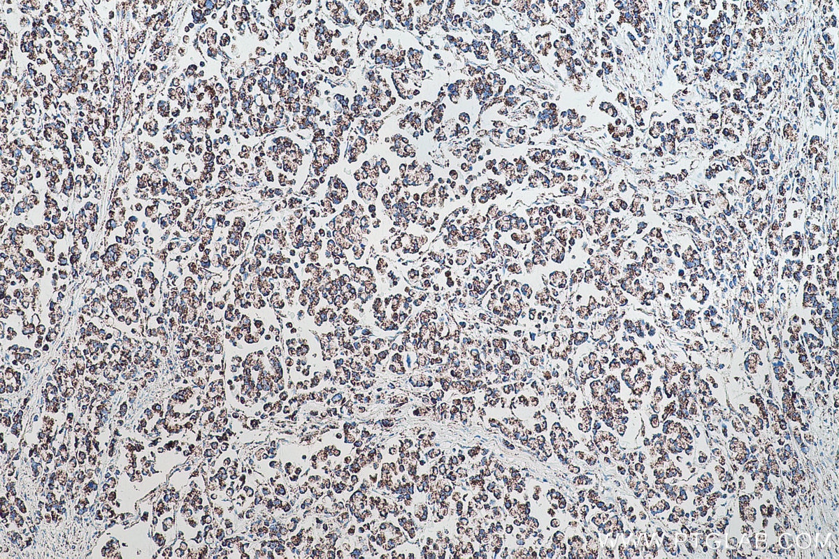 Immunohistochemical analysis of paraffin-embedded human colon cancer tissue slide using KHC0510 (ATP5B IHC Kit).